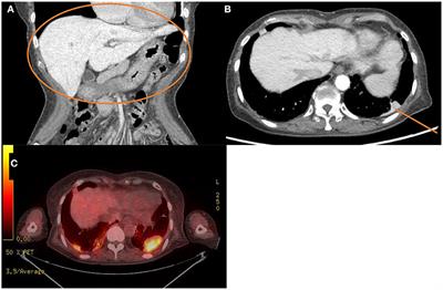 Amiodarone-Induced Multi-Systemic Toxicity Involving the Liver, Lungs, Thyroid, and Eyes: A Case Report